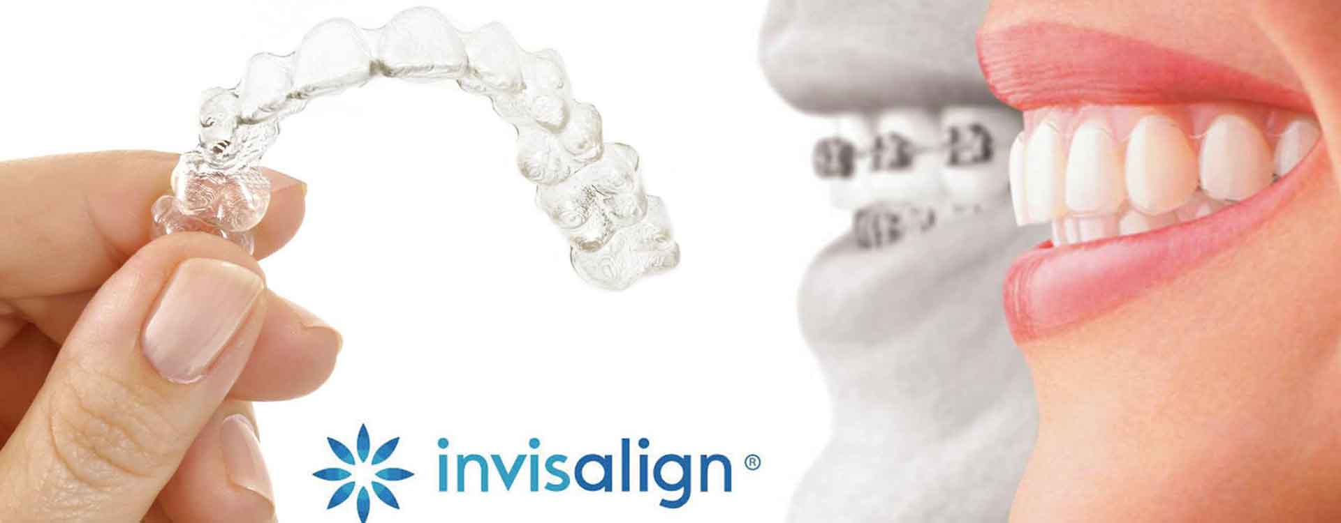 Ортодонтическая система Инвизилайн